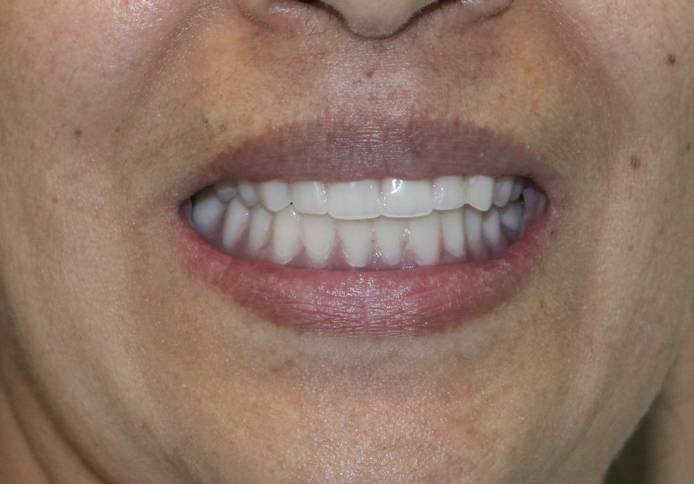 before___after_photos-Implant-retained-denture-after