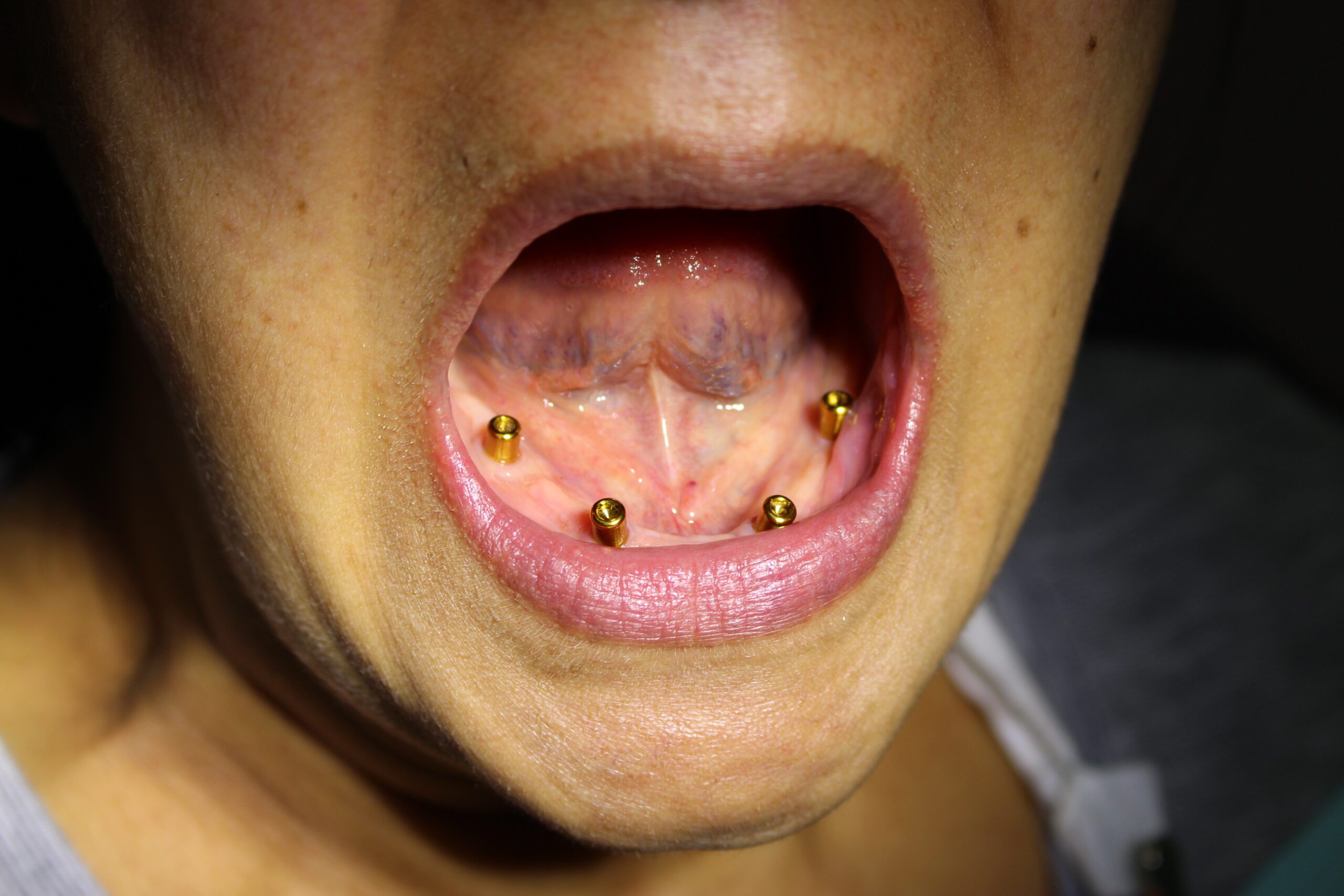 before___after_photos-Implant-retained-denture-before before___after_photos-Implant-retained-denture-before