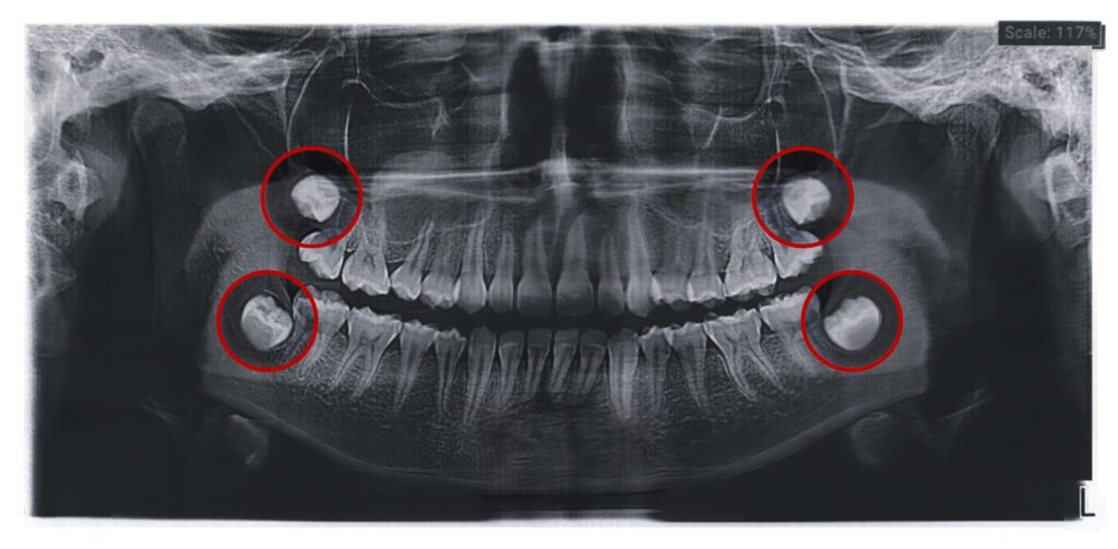 wisdom teeth removal San Bernardino dentist