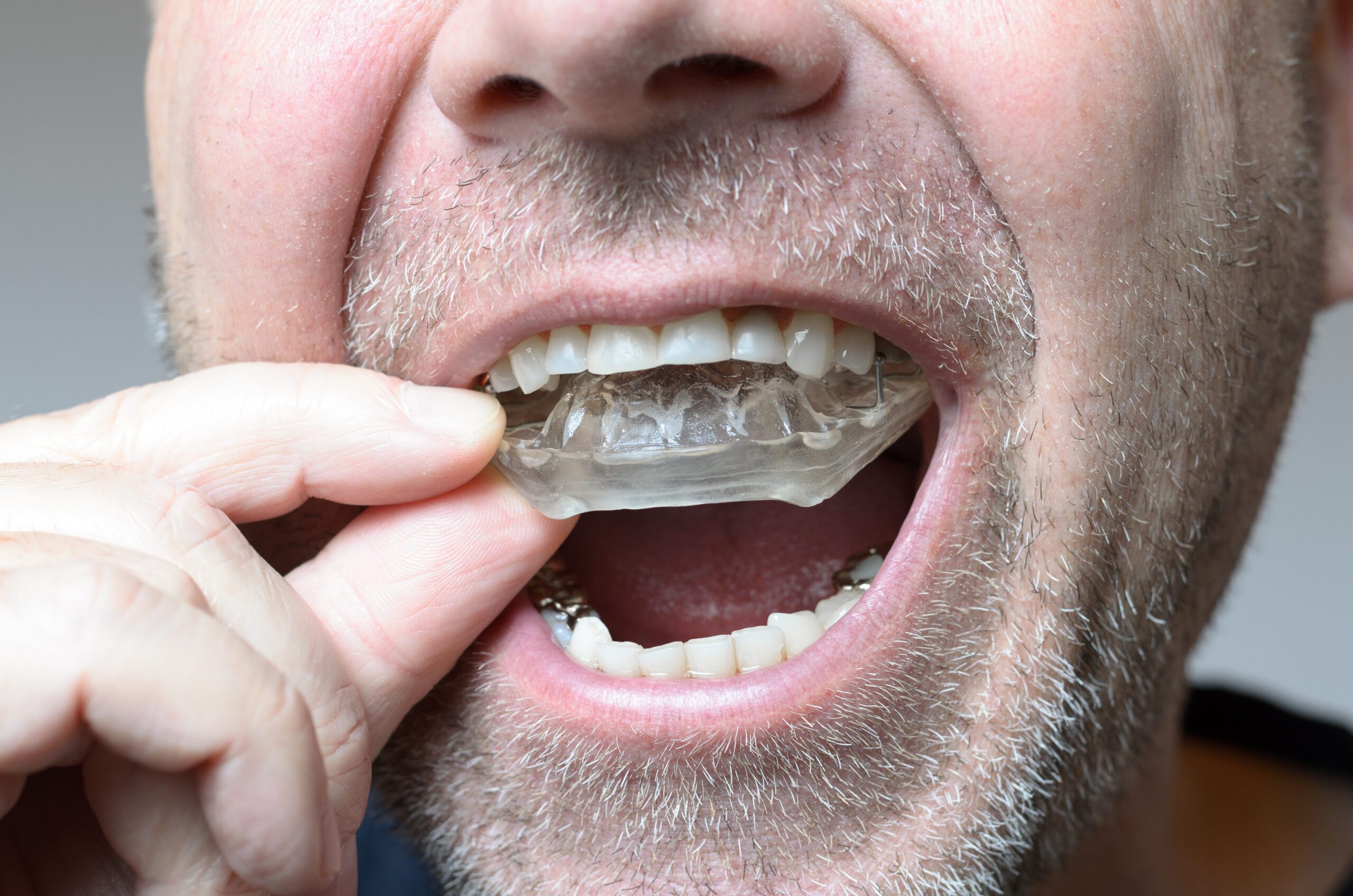 Invisalign in San Bernardino